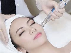 Laser Trị Nám Tàn Nhang